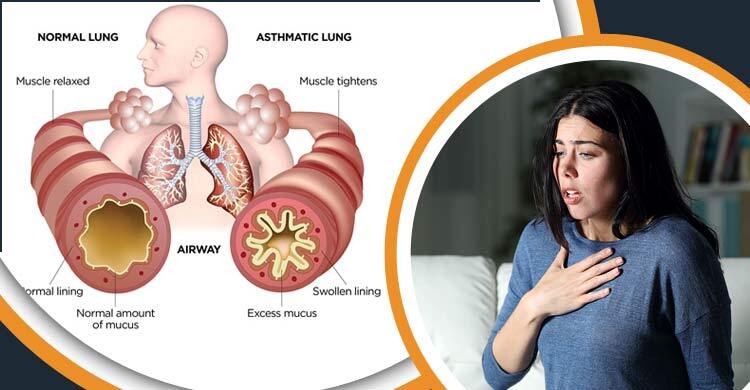 গরমে কেন বেড়ে যায় অ্যাজমা? শ্বাসকষ্ট হলে কী করবেন?